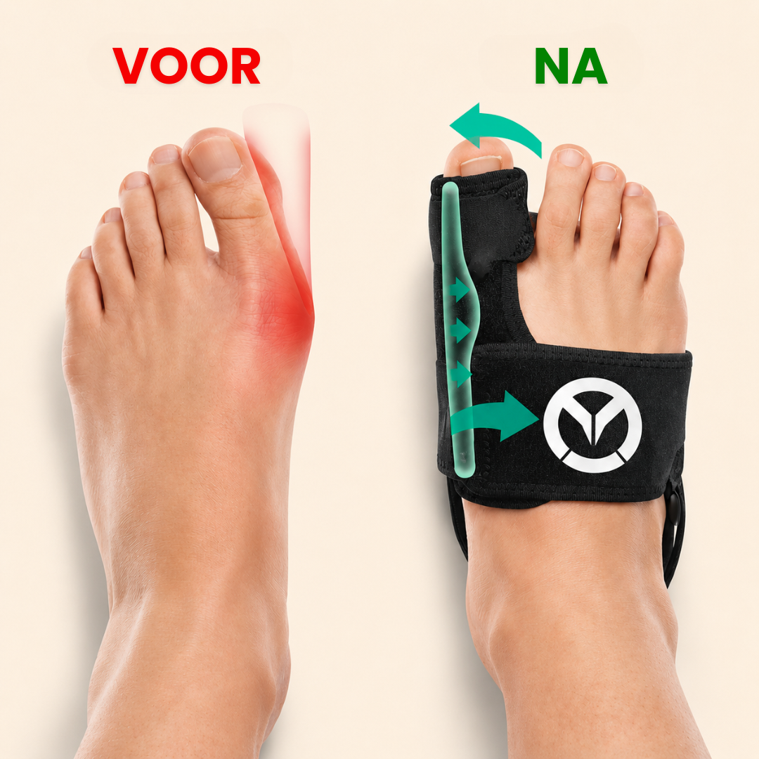 Valgux Brace | Teencorrector bij scheefstand (Hallux Valgus)