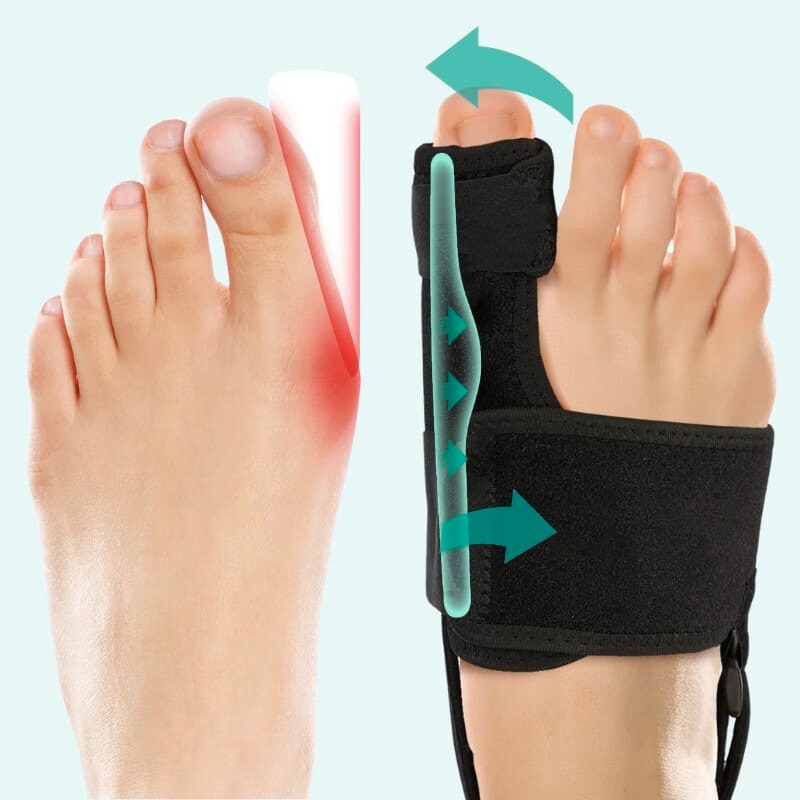 Valgux Brace | Teencorrector bij scheefstand (Hallux Valgus)